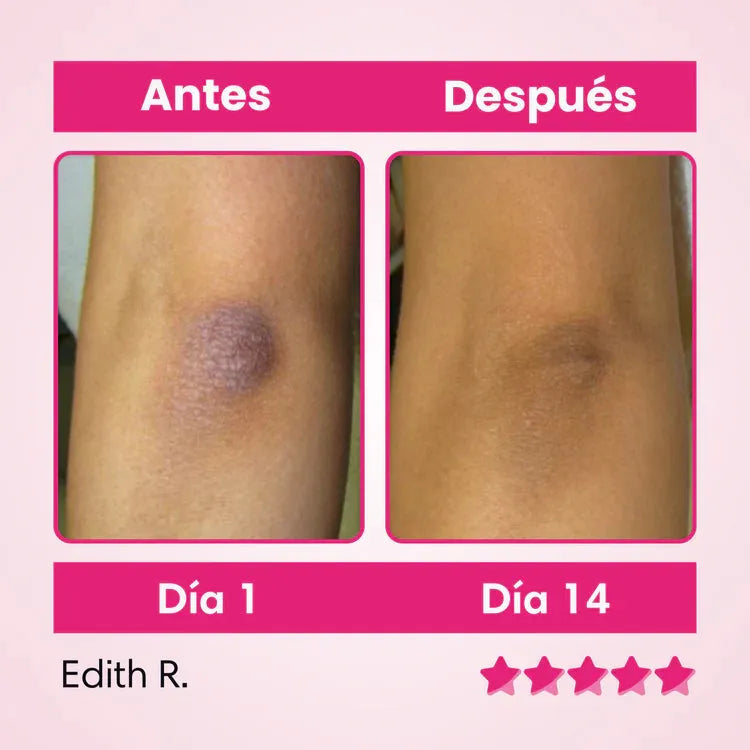 🌸 BellaLuz 🌸 Crema Blanqueadora Hipoalergénica – Despídete de las manchas oscuras de tu piel antes de Navidad.